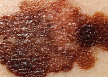 Come prevenire i tumori della pelle: il melanoma