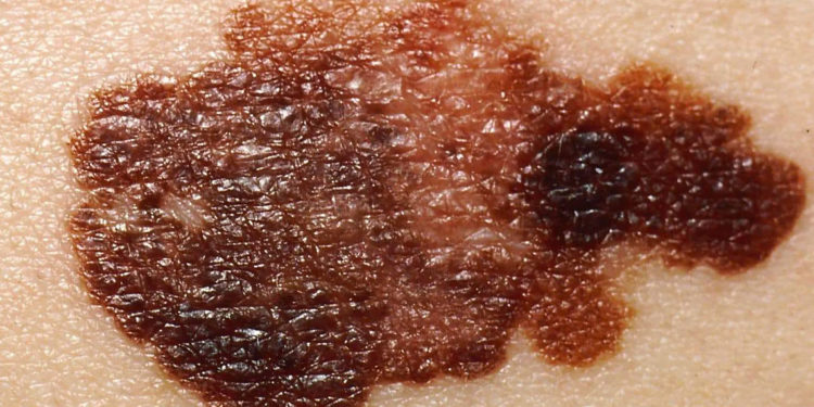 Come prevenire i tumori della pelle: il melanoma