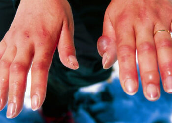 Geloni: cause e rimedi