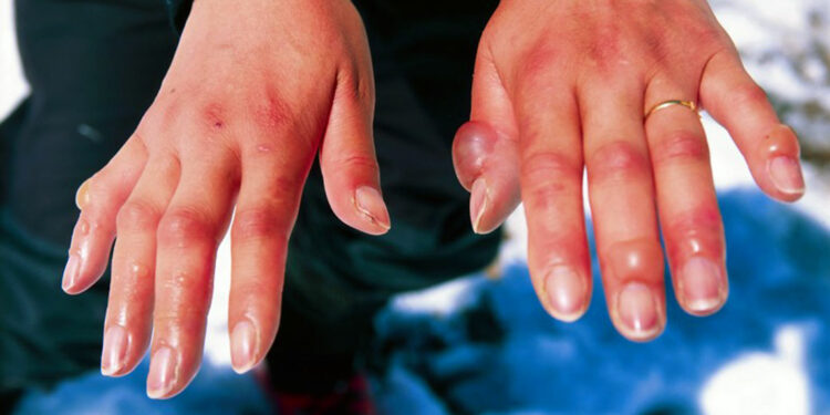 Geloni: cause e rimedi